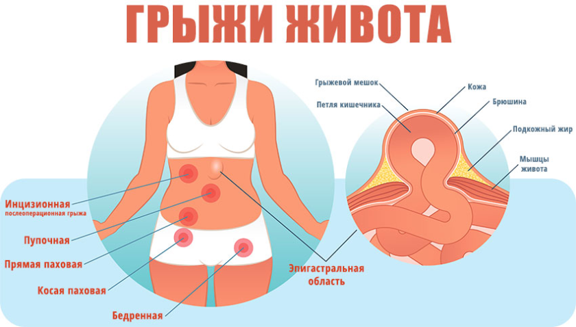 Паховая грыжа: операция и восстановление